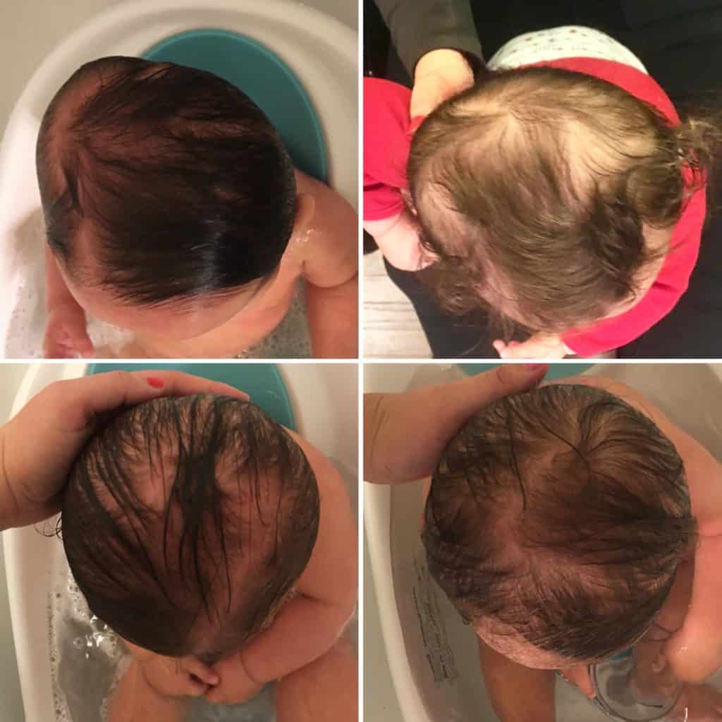 STARband Plagiocephaly treatment correction - from flat to round