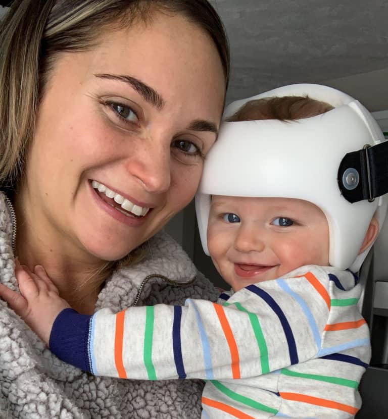 Plagiocephaly baby receiving helmet therapy treatment with STARband Cranial Remolding Orthosis