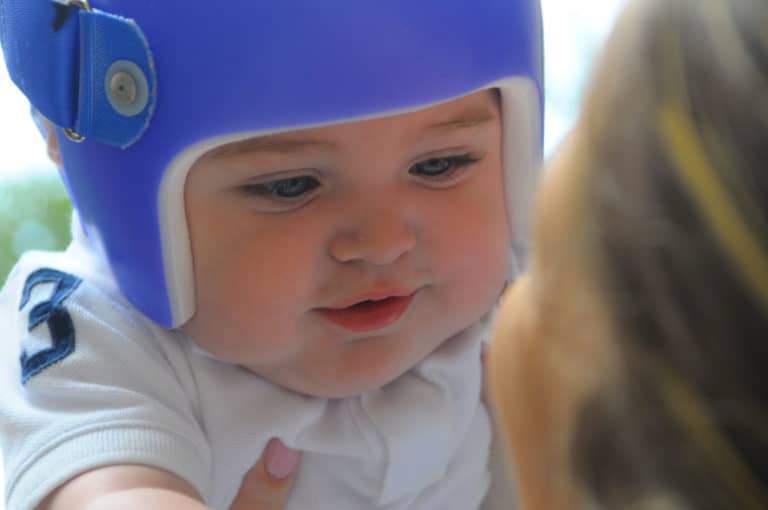 Plagiocephaly baby receiving helmet therapy treatment with STARband Cranial Remolding Orthosis