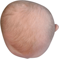 Baby with Plagiocephaly head shape, before treatment